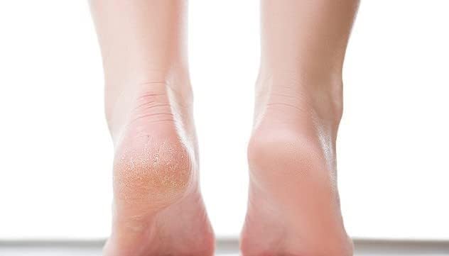 Ever Ready Corn & Callus Trimmer - Instant Relief from Corns | Removes Dry, Hard & Cracked Skin | Home Pedicure Treatment for Footcare + 4 x Replacement Blades