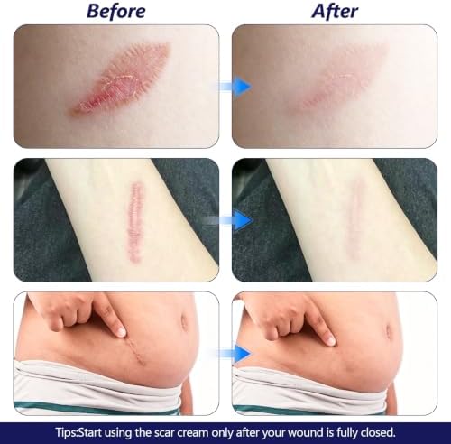 2Pcs Scar Cream,Advanced Silicone Scar Gel for Old & New Scars,100g(3.6OZ) - Image 7