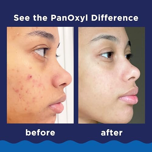 PanOxyl 10% Benzoyl Peroxide Acne Foaming Wash, Maximum Strength, Daily Acne-Fighting Face and Body Cleanser, Face Wash to Clear, Treat and Prevent Acne Pimples and Stubborn Breakouts, 5.5 Oz Tube - Image 4