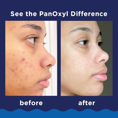 PanOxyl Acne Foaming Wash, 10% Benzoyl Peroxide, 5.5 oz, Pack of 2 - Image 3