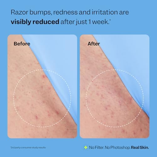 Peach Slices - Smoothing Solution Ingrown Hair Treatment (1.69 oz) - Smooth, Relieve, Soften Skin - 360 Roller - BHA, AHA, PHA, Niacinamide, Licorice - Vegan & Cruelty Free - Korean Skin Care & Beauty - Image 6