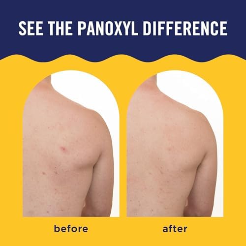 PanOxyl Acne Banishing Body Spray, 2% Salicylic Acid, For Body, 6 oz - Image 4
