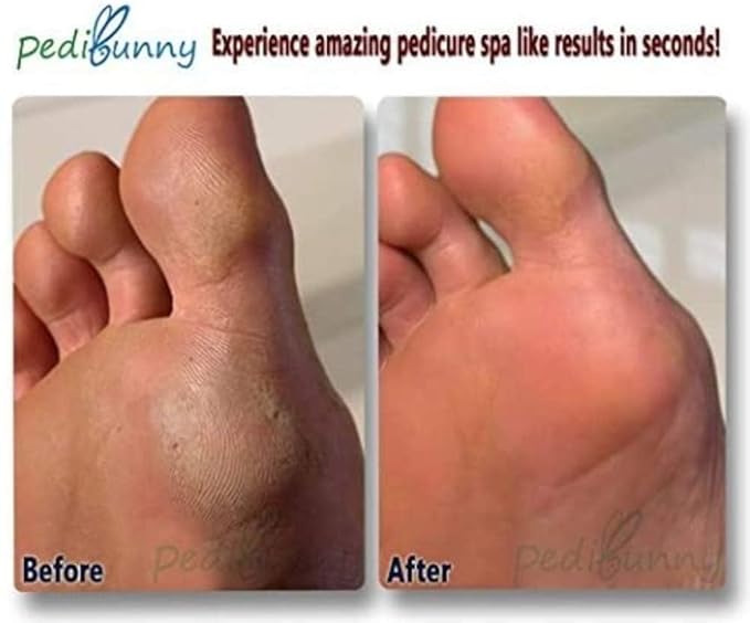 Electric Foot Callus Remover - Rechargeable Electronic Foot File - Professional Pedicure Tools with 3 Rollers - Foot Scrubber for Dry Cracked Feet and Dead Skin - Foot Sander for Men and Women
