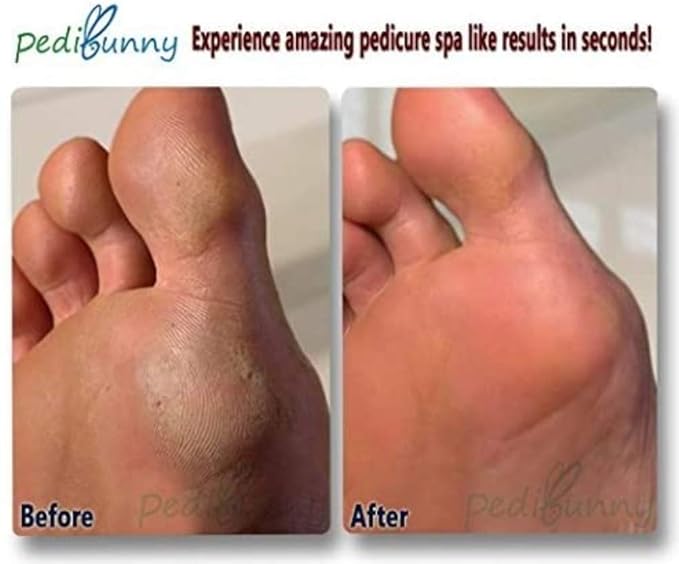 Electric Callus Remover for Feet - Rechargeable Foot File and Dead Skin Remover with 3 Rollers - Professional Pedicure Tool and Foot Sander for Cracked Heels, Hard Calluses - Waterproof Foot Scrubber