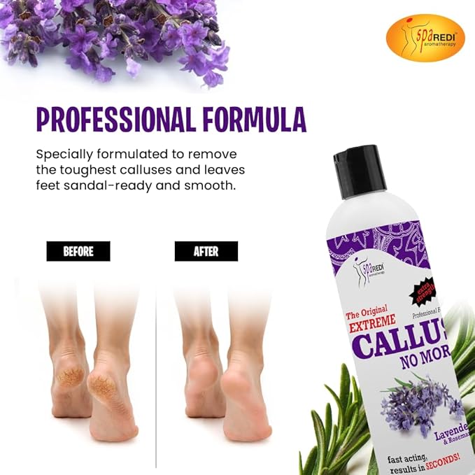 SPA REDI Callus Remover - Professional-Grade Callus Dissolving Treatment - Stop Scraping. Start Dissolving. Chemically Dissolve Toughest Buildup for a Dramatic 'Wow' Transformation 12 Oz
