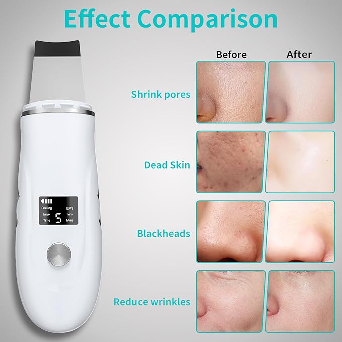 Face Spatula Blackhead Remover - 4 Modes Deep Cleansing Pore Extractor, Fast Charging Skin Scrubber for Women Facial Skincare Gift