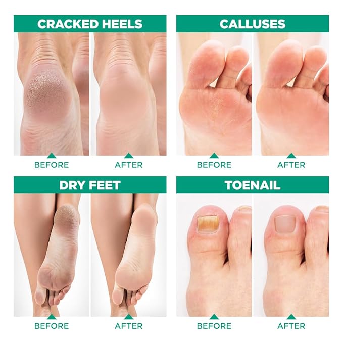 Tea Tree Oil Foot Soak with Epsom Salt - Made in USA - for Toenail Health, Athletes Foot, Stubborn Foot Odor, Softens Calluses & Soothes Sore Tired Feet - 2 LB