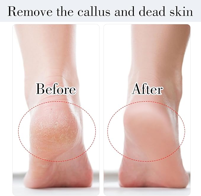JIEYAO Stainless Steel Foot File, Metal Foot Scraper, Professional Foot File Callus Remover Double-Sided Foot Rasp Scrubber Pedicure Foot Care Tools for Wet & Dry Skin Heel Grater for Feet