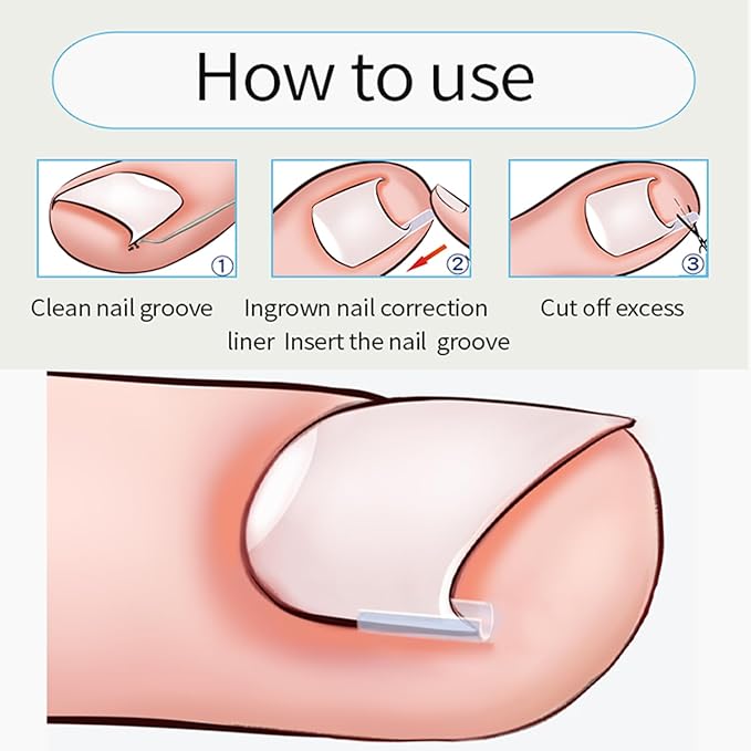 Ingrown Toenail Corrector Set with Correction Strips,Professional Ingrown Toenail Tool kit,Curved Toenails Corrector Patch,For Home Pedicure Care