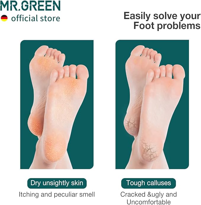 MR.GREEN Foot File Double Sided Pedicure Foot Care Tools Professional Callus Remover Foot Rasp Stainless Steel Foot Scrubber for Feet (Orange)