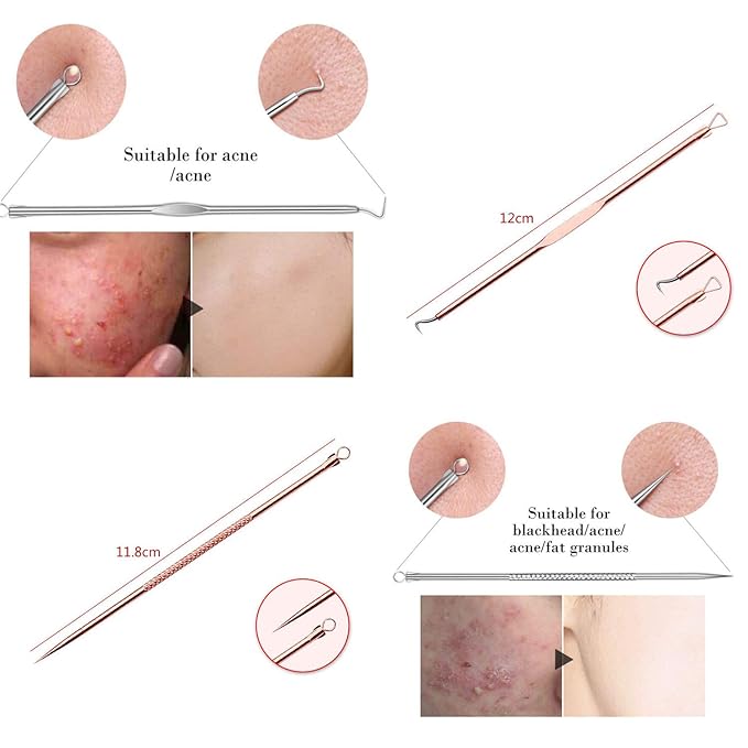 ZTRHYOO Blackhead Remover Pimple Comedone Extractor Tool Best Acne Removal Kit - Treatment for Blemish, Whitehead Popping, Zit Removing for Risk Free Nose Face Skin with Case (Rose)