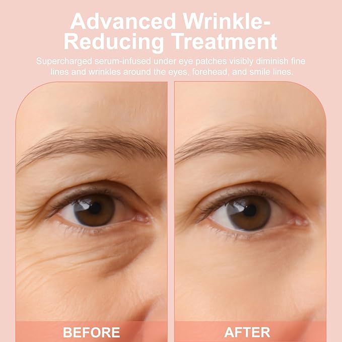 Micro Eye Patches, Under Eye Patches for Puffy Eyes, Dark Circles & Fine Lines, Deeply Hydrating Anti-Wrinkle Patches, Smooth Application Forehead & Smile Line Patches (2)