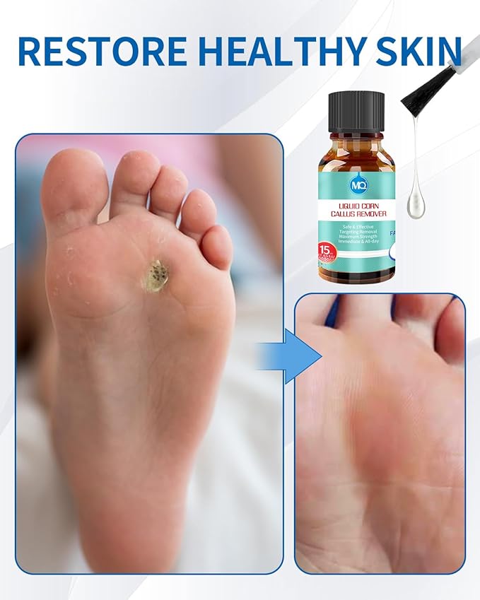 MQ Professional Corn & Callus Remover Liquid for Feet & Toes – Fast Acting for Corn Removal, Hard Skin & Dead Skin – Includes 15ML Solution + 15 Cushions + 10 Swabs – Effective Foot Care Solution