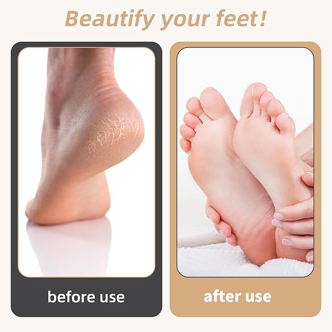 Electric Foot Callus Remover, Electronic Foot File, Portable Electric Callus Remover for Feet, Pedicure Tools for Dead Skin Calluses (White)