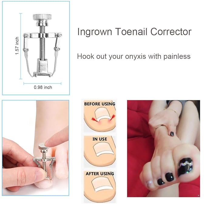 Bcabo 10Pcs/set Ingrown Toenail Tools Kit, Nail Treatment Foot Tool,Ingrown Toenail Removal Correction Clippers, Surgery Grade Nail File Lifter, Professional Pedicure Tool