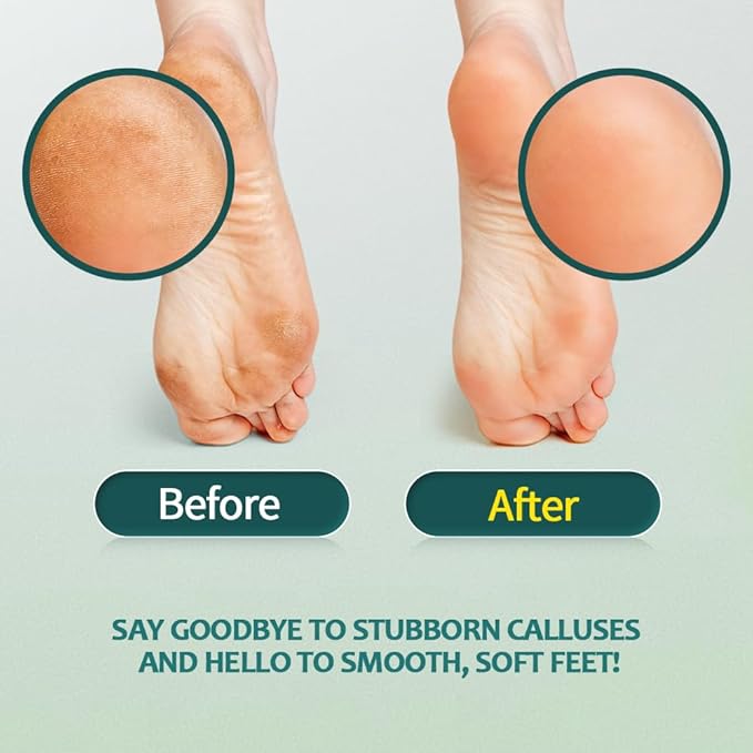 Gorgellux Callus Remover for Feet, Callus Remover Gel & Foot File Kit, Foot Callus Remover Gel Set for Dead Skin, Salon Pedicure Spa Kit, Callus Remover for Feet Gel, White