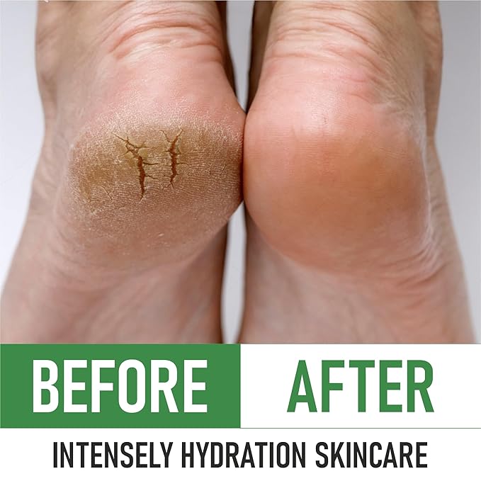 PurOrganica Urea Cream 40% – Made in USA, Maximum Strength Foot Cream for Dry, Cracked Heels, Corns, Calluses & Rough Feet, Exfoliating Moisturizer - Pack of 3