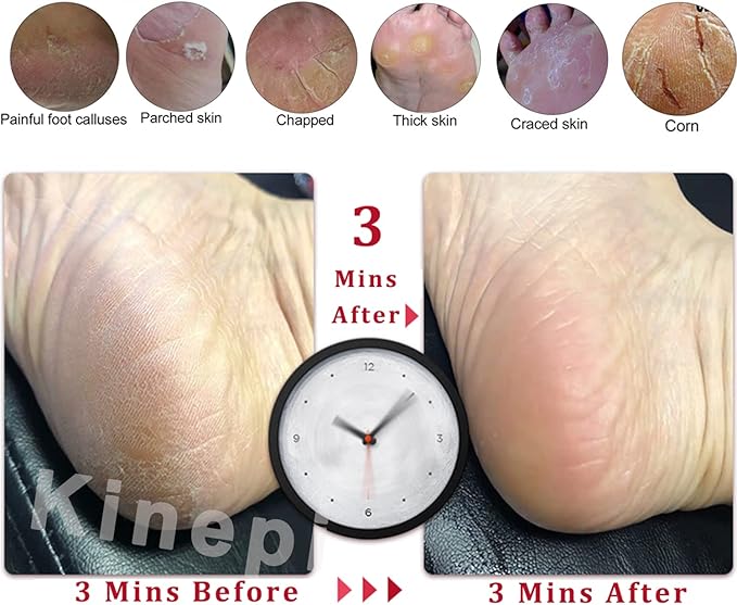 Kinepi Feet Callus Removers Professional Colossal Foot Scrubber Pedicure Foot File Foot Massager Pumice Stone for Feet,Remover Corn Hard Skin Dead Skin Exfoliator for Use in Shower Feet Care Tools