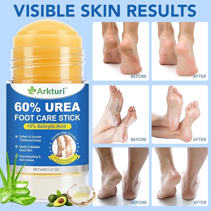 ABOUME 60% Urea Foot Care Stick with 2% Salicylic Acid, Urea Foot Cream for Dry Cracked Feet, Knees, Elbows, Avoid Frostbite, Heel Balm for Callus Remover & Dead Skin Softener (1PCS)