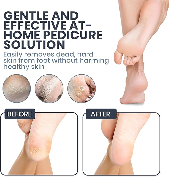 Upgraded 2026 Electric Foot File – Callus Remover for Women & Men with Adjustable Speed, 60 Sanding Pads & Dead Skin Exfoliation – at-Home Pedicure Tool for Dry, Cracked Feet (Pink)