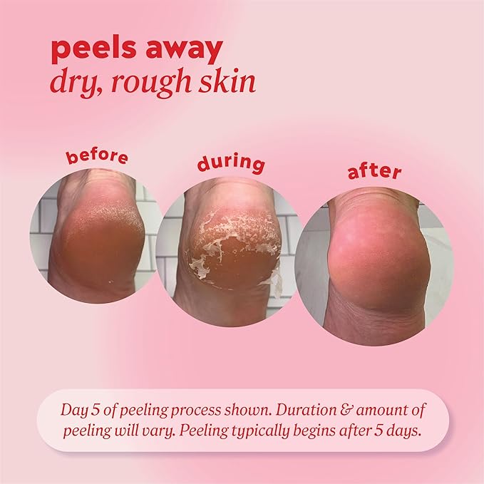 Onyx Professional Foot Peel Mask Callus Remover, 2 pack - Dead Skin Remover, Foot Exfoliator, Cracked Heel Treatment, Peeling Callus Removing Foot Mask Pedicure Kit For Smooth Soft Healthy Feet