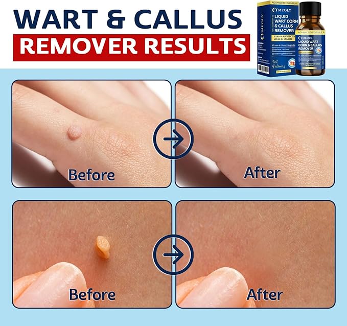 MEOLY Fast-Acting Wart Remover Freeze Off : Salicylic Acid Wart Remover for Plantar Wart, Corn Freeze Off Fast-Acting for Men and Women 30 ML