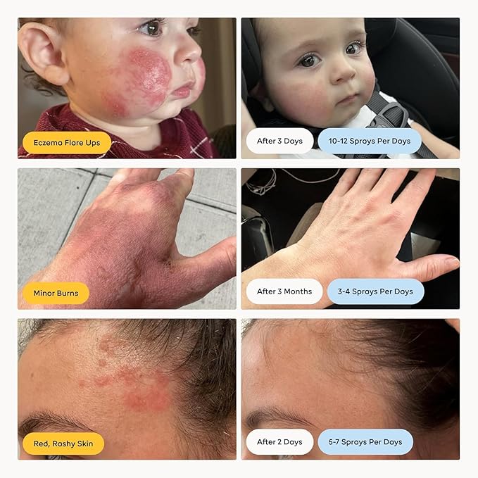 Magic Molecule Hypochlorous Acid Spray for Breakout-Prone Skin, Eczema & Itchy Rashes | Helps 50+ Dermal Issues | For All Skin Types 3.4 oz (Pack of 2) Travel-Friendly