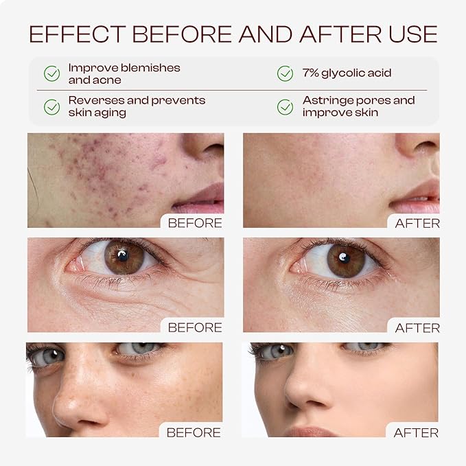 Glycolic Acid Toner: 240ml Glycolic Acid 7% Exfoliating Toner Toning Solution Which Soothes and Hydrates Skin