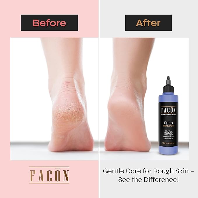 Facón Professional Callus Remover Gel for Feet with Aloe Vera, Shea Butter, Peppermint & Witch Hazel, Lavender Scent Callus Softener, Home Pedicure Foot Spa, Removes Cracked & Dead Dry Skin, 10 fl oz