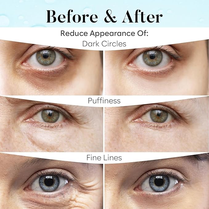 BLOOMORA Retinol & Collagen Under Eye Patches (30 Pairs), Under Eye Mask for Puffy Eyes, Appearance of Dark Circles, Smoothing & Hydration, Self Care & Skincare Gifts for Women, Patch Yeux