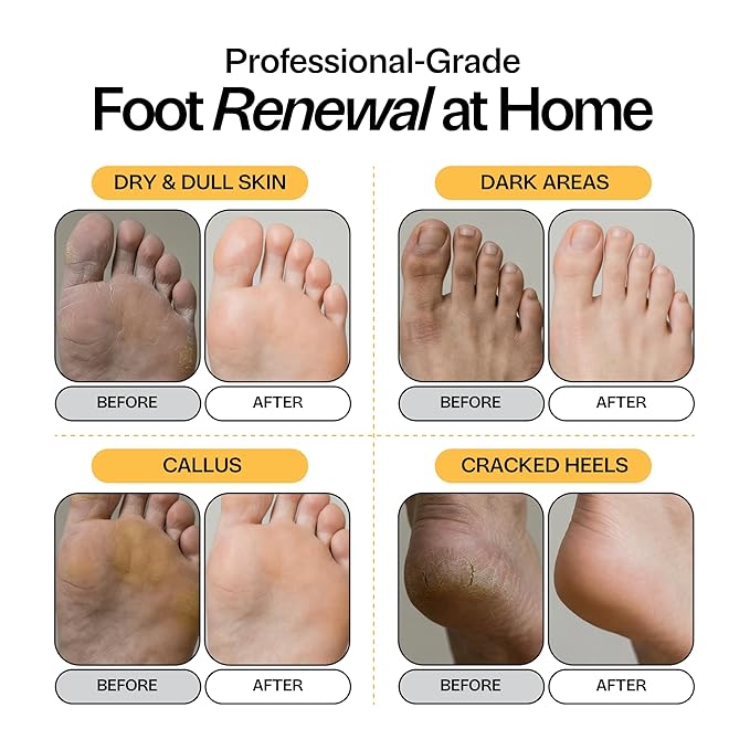 Skin Brightening Foot Soak with Kojic Acid & Niacinamide - Evens Skin Tone, Boosts Glow & Softens Calluses - Turmeric & Vitamin C - 1lb