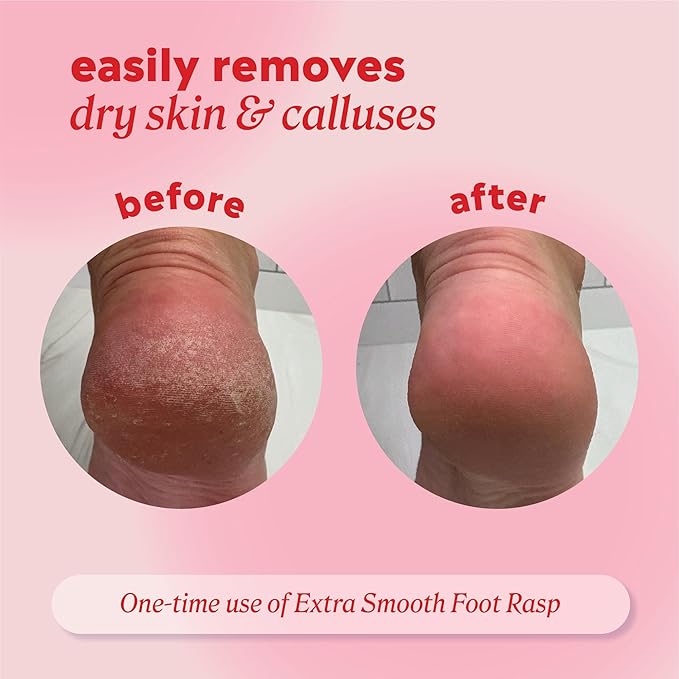 Onyx Professional Foot Rasp, No Mess Callus Remover for Feet, Includes Debris Catcher - Stainless Steel Foot Scrubber Dead Skin Remover, Lightweight Callus Shaver for Feet, Foot File, Pedicure