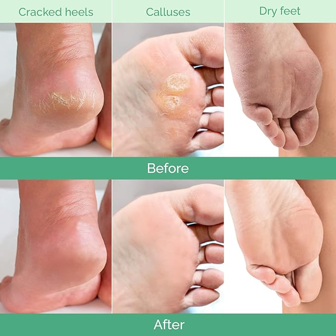 PLANTIFIQUE Foot Peeling Mask 4 Pack | Dermatologically Tested Repairs Heels & Removes Dry Dead Skin for Baby Soft Feet | Exfoliating Foot Peel Mask for Dry Cracked Feet