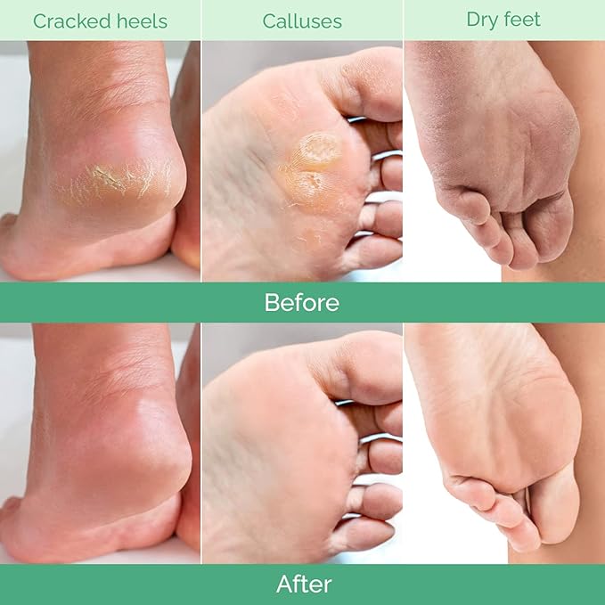 PLANTIFIQUE Foot Peeling Mask - Peeling Foot Mask Dermatologically Tested Repairs Heels & Removes Dry Dead Skin for Baby Soft Feet (Jasmine, 1 Count (Pack of 2))