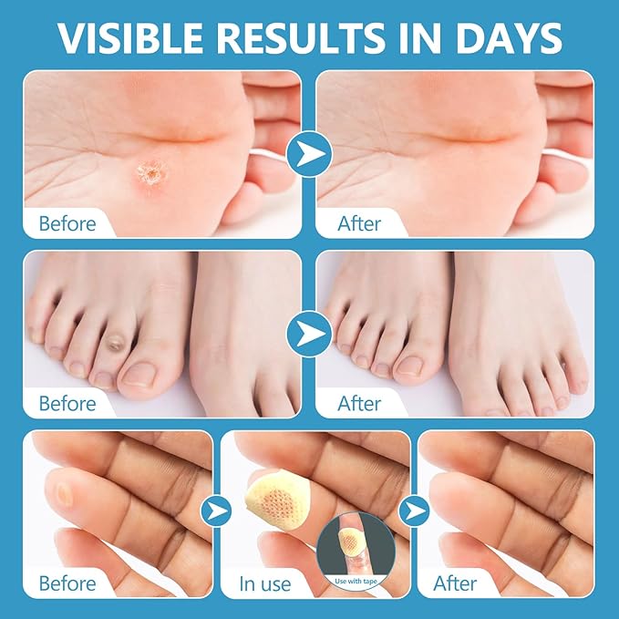 Corn removers for Toes feet Bottom of Foot Corn Remover,Corn Pads Callus Remover for Toes feet with 40% Salicylic 36 Count