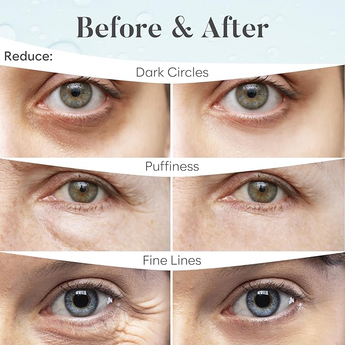 AURAE Hyaluronic Acid Under Eye Patches (30 Pairs) - For Dark Circles & Puffiness - Hydrating Eye Mask for Care
