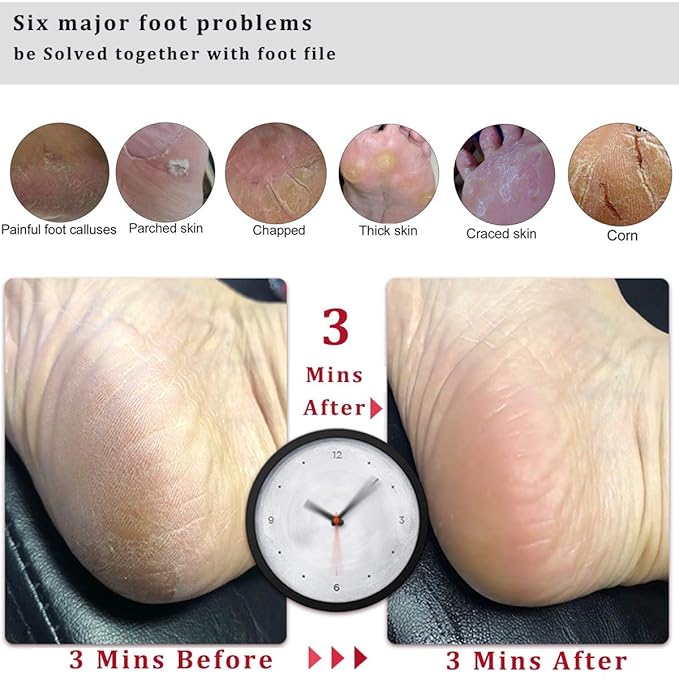 Kinepi Foot Scrubber Pedicure Foot File Pumice Stone,Professional Pedicure Supplies Callus Remove Cracked Heels,Dead Skin,Corn,Scraper File Foot Care Foot Rasp Massage Brush Tools Kit for Men/Women
