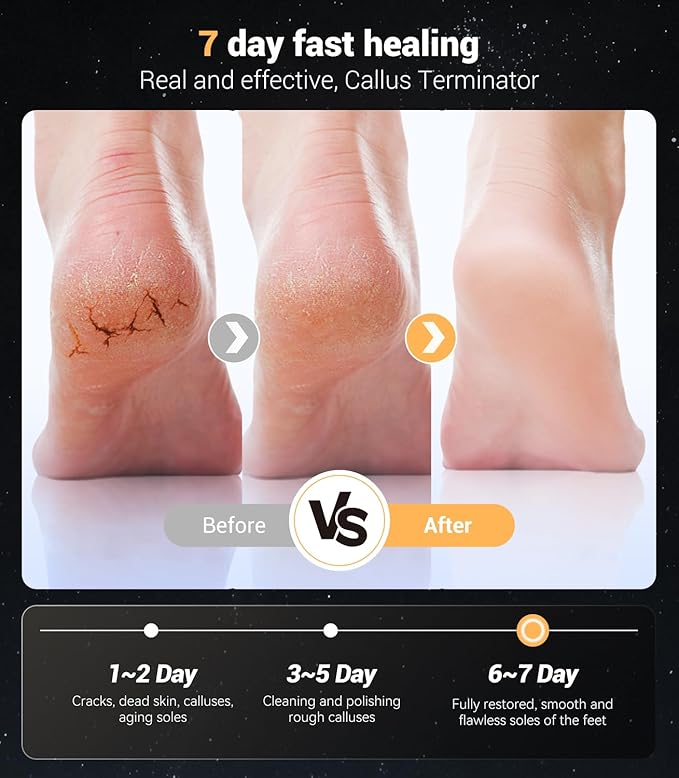 Electric Foot Callus Remover,Rechargeable Electric Callus Remover for Feet【Variable 3-Speed & LED Light】【Removes 99.92% of Calluses】 Portable Foot File Pedicure Kits with 30 Grit Pads-Pink
