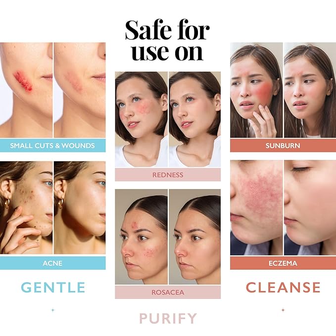 Hypochlorous Acid Spray for Face and Skin; Facial Cleanser | 32oz Refill Face Mist Hypochlorous Acid Spray for Skin, Acne, Rash, Eczema, Wound | Antimicrobial Facial Cleanser Acne Mist; Smart Skincare