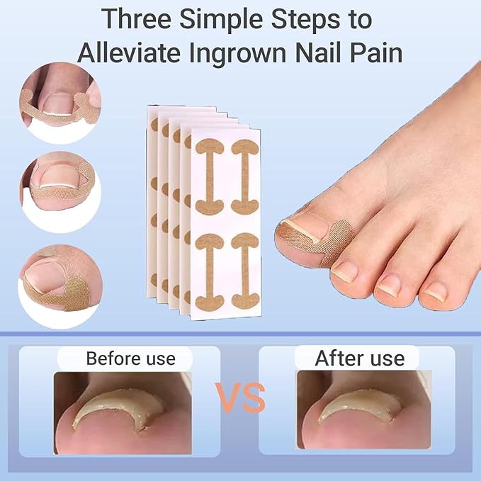 Ingrown Toenail Corrector Set with Treatment Tools & Correction Strips, Professional Pedicure Tools for Feet – Painless Ingrown Toenail Treatment and Home Care Solution for Men and Women (1Set)