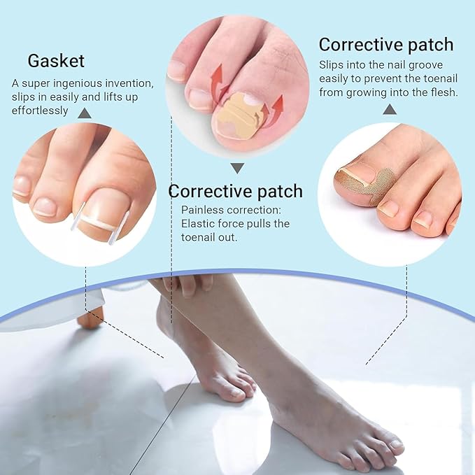 Ingrown Toenail Corrector Set with Treatment Tools & Correction Strips, Professional Pedicure Tools for Feet – Painless Ingrown Toenail Treatment and Home Care Solution for Men and Women (1Set)