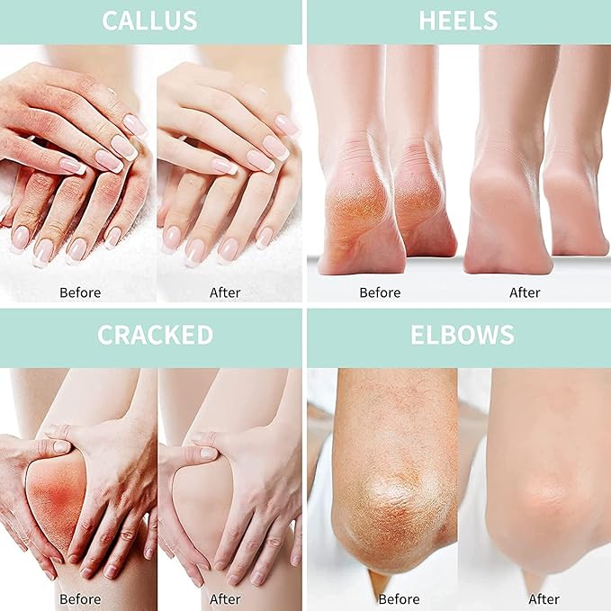 Grocerism Urea Cream 40 Percent For Feet Plus 2% Salicylic Acid 8.82 oz || Foot Cream and Hand Cream Maximum Strength with Hyaluronic Acid, Tea Tree,and Aloe Vera for Deep Moisturizes, Callus Remover