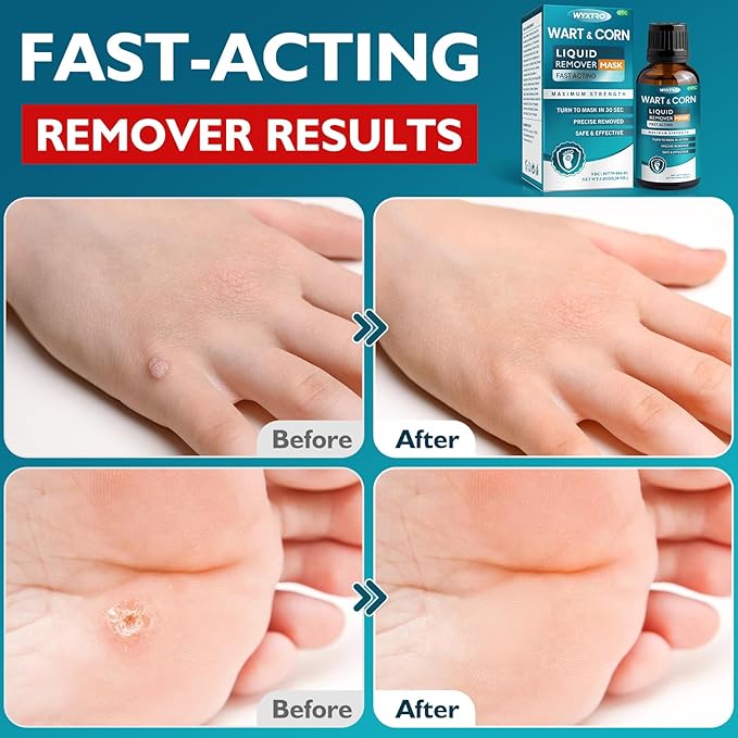 Wart Remover Freeze Off, Wart Corn Removers for Toes, 17% Salicylic Acid Fast-Acting Wart Removal Liquid with Soothing Botanicals for Plantar Wart, Common Wart, Flat Wart, Corn, Callus - 30ML