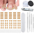 Ingrown Toenail Corrector Set with Treatment Tools & Correction Strips, Professional Pedicure Tools for Feet – Painless Ingrown Toenail Treatment and Home Care Solution for Men and Women (1Set)
