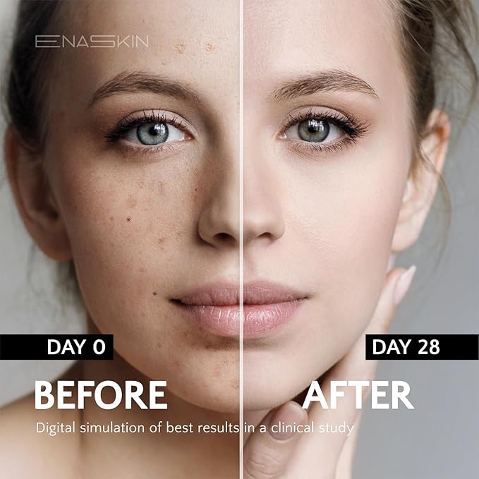 EnaSkin Dark Spot Remover Face & Body Serum: Age Spot Sun Spot Freckles Melasma Brown Spot - Advanced Formula with Niacinamide for Women and Men (1.0 Fl Oz)