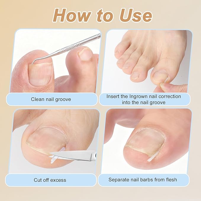 VOCOSTE Ingrown Toenail Correction Kit, Toe Nail Corrector Tools with Leather Case for Easy Storage & Travel, for Curved & Ingrown Nails with Nail Files Clipper Lifter