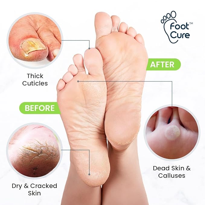 FOOT CURE Exfoliator & Callus Remover Pedicure Set – Care Kit Includes File for Dead Skin, Tea Tree Oil Soak Salts, Urea Cream 40 Percent Removal Gel Made in USA, 4 Piece