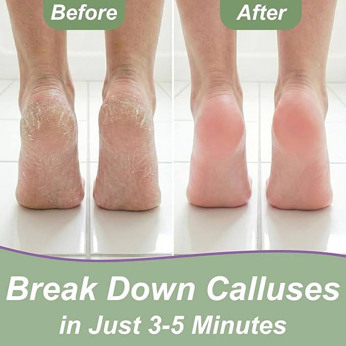 Dr. Entre's Callus Remover Gel: Extra Strength Callus Remover for Feet, Foot Callus Remover, Foot Care, Pedicure Tools Supplies, Dead Skin Remover, 4 oz
