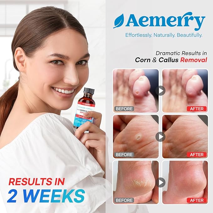 Aemerry Corn Removers for Toes Foot: Liquid Salicylic Acid 17% Corns Calluses Removal Extra Strength, Fast Acting Corn Remover for Feet Fingers. 30ml