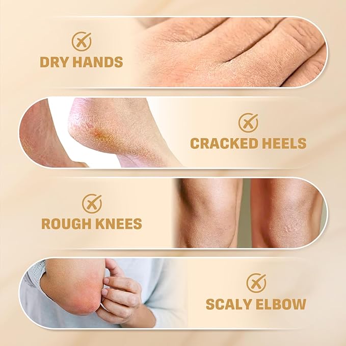 2Pack 60% Urea Cream with 2% Salicylic Acid, Urea Cream 60 Percent for Feet & Hands- Maximum Strength Moisturizer for Rough, Dry, Thick & Cracked Skin,Callus Remover, Deep Hydration, 150g